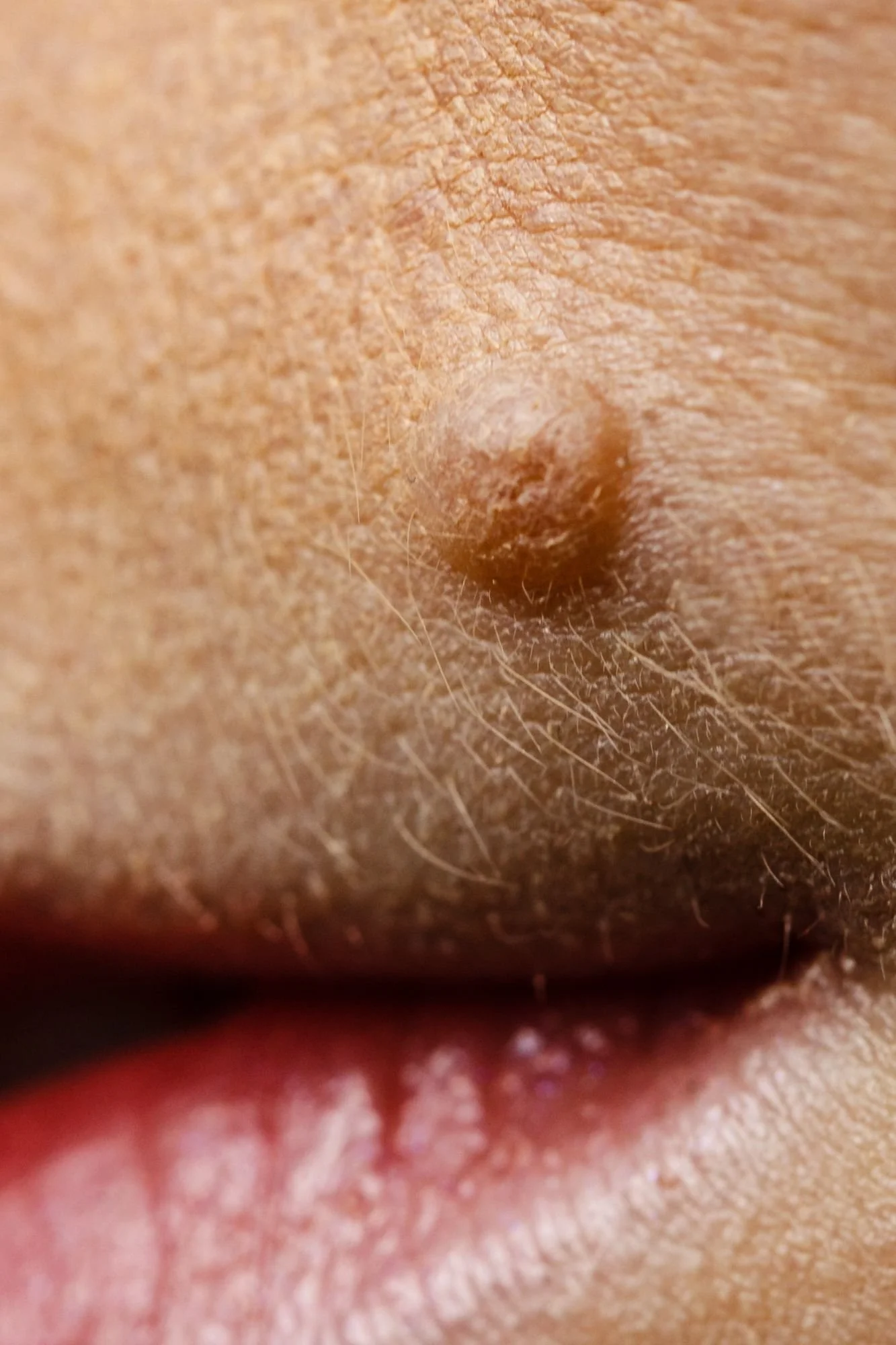 Close-up of white skin coloured mole before removal