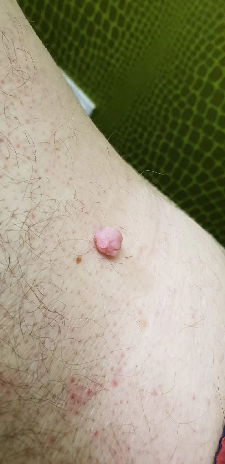 Raised, skin-coloured large pink skin tag before removal - the skin blemish clinic