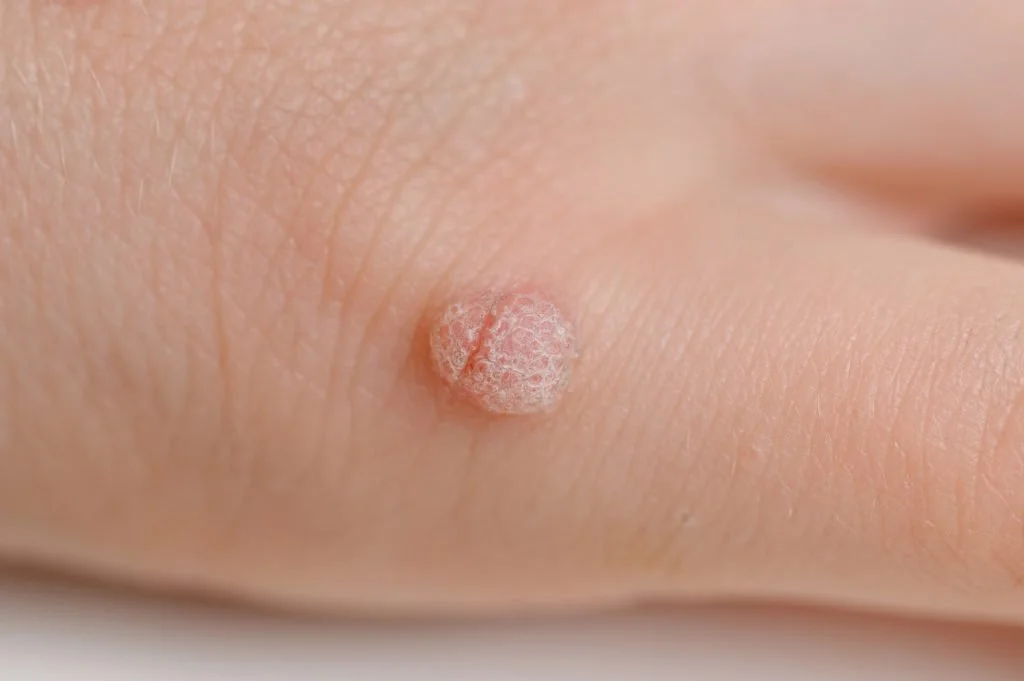Close-up of skin with a raised, round skin coloured wart on hand before removal at the blemish removal clinic dublin 6