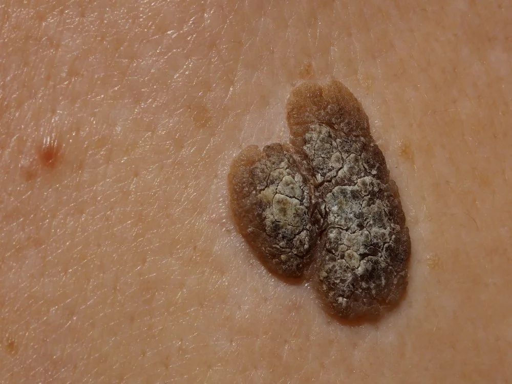 Close-up of a rough, crusty Seborrhoeic Keratosis spot before treatment at dublin blemish clinic