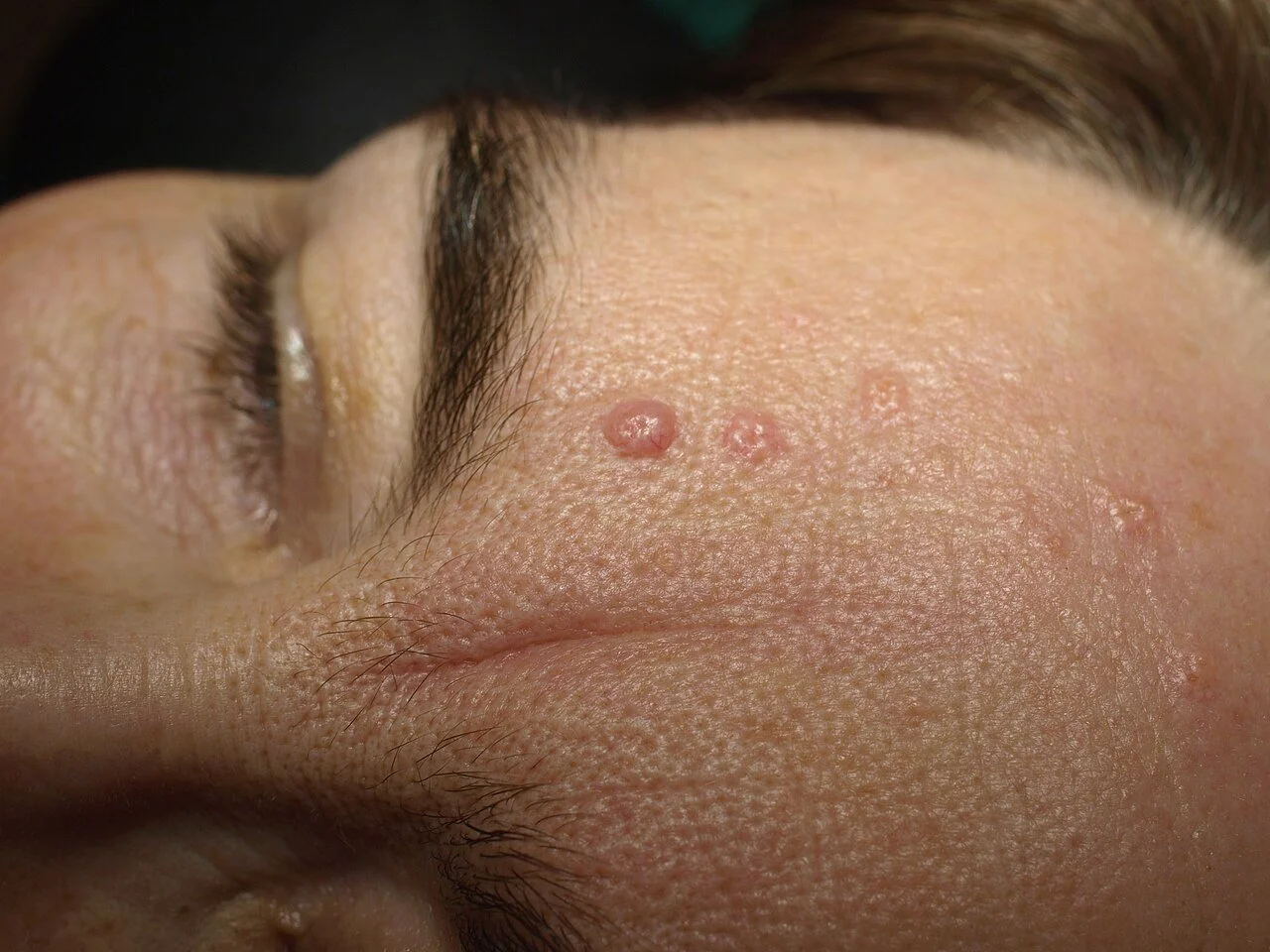 Close-up of a person's forehead showing small, raised Sebaceous Hyperplasia pimples and blemishes before removal