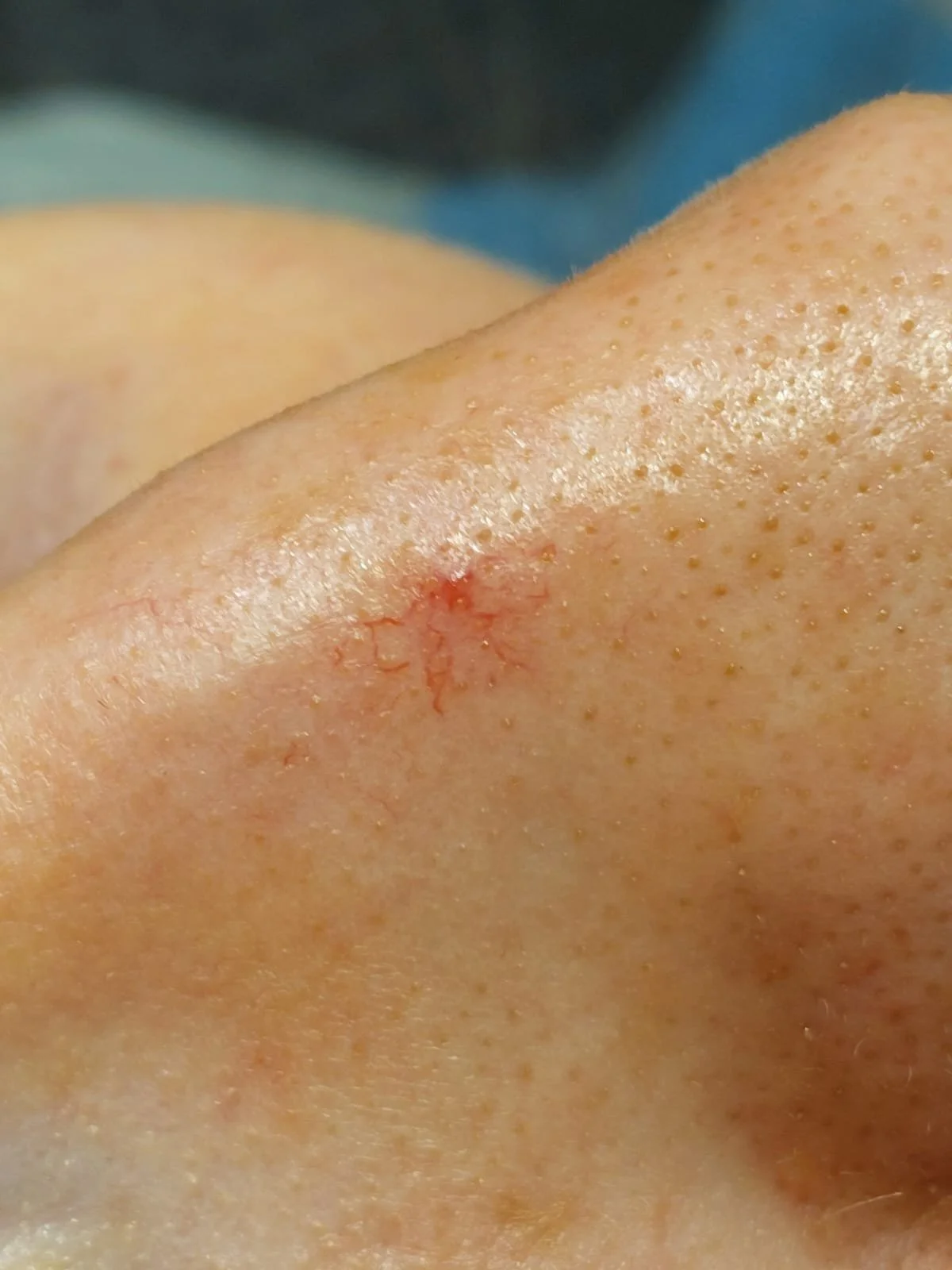 Close-up of red facial thread veins before removal at dublin skin blemish clinic
