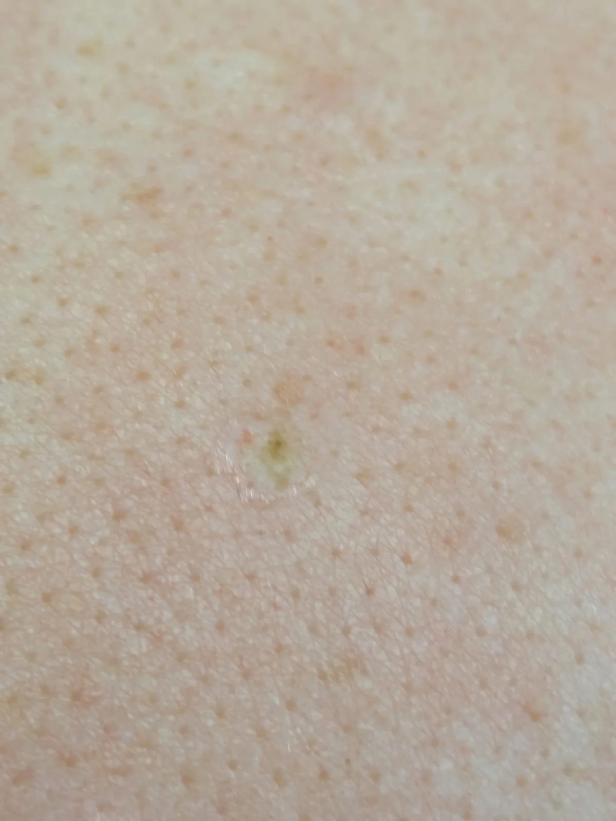 Close-up of a Seborrhoeic Keratosis blemish after advanced electrolysis treatment at dublin blemish clinic