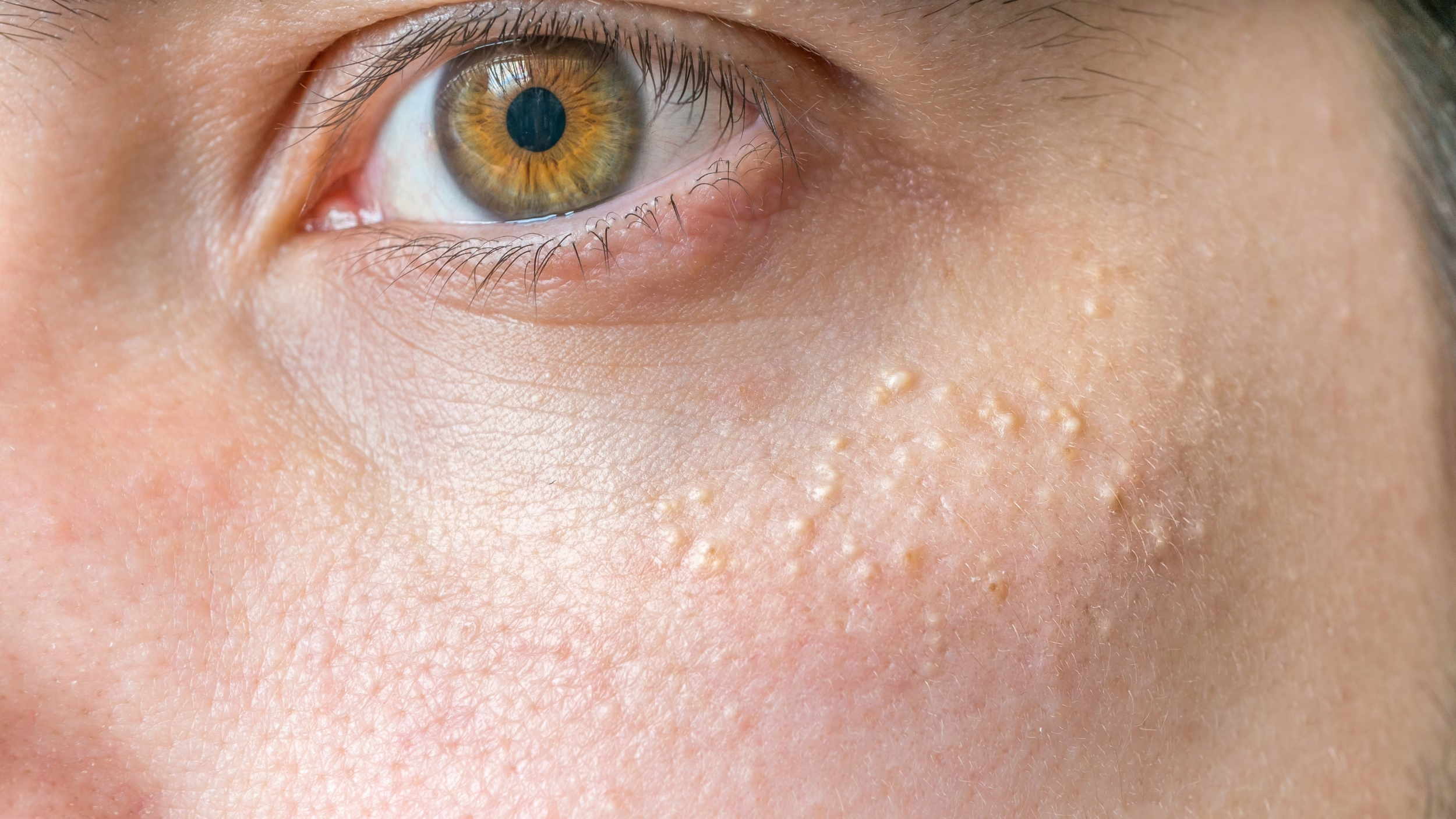 Close-up of a human eye with small keratin Milia blemishes in under eye area before treatment