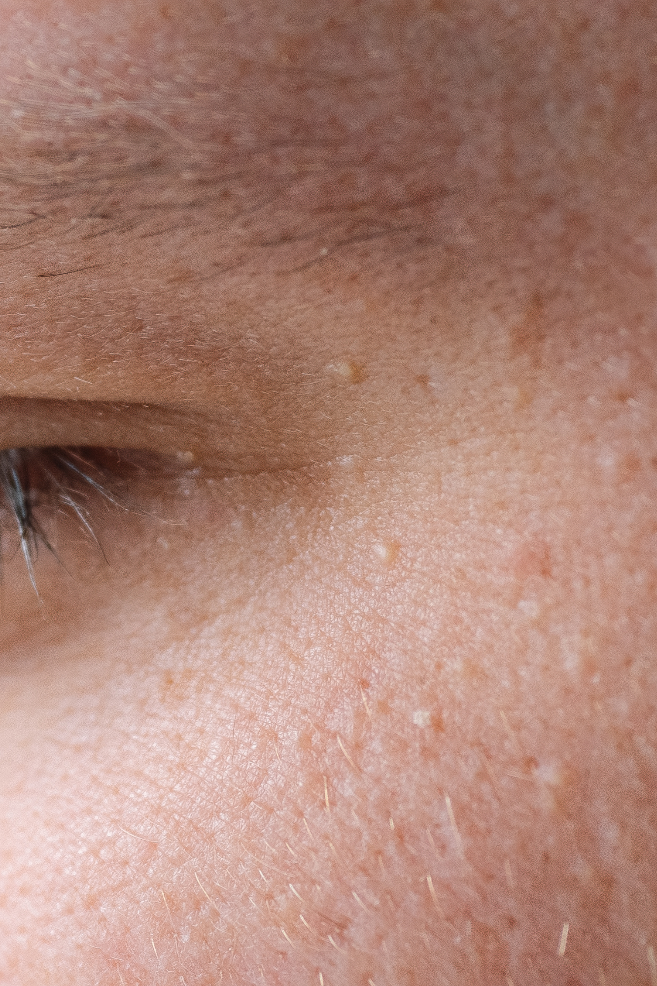 Close-up of human skin by the eye showing small keratin filled milia blemishes before removal at clinic