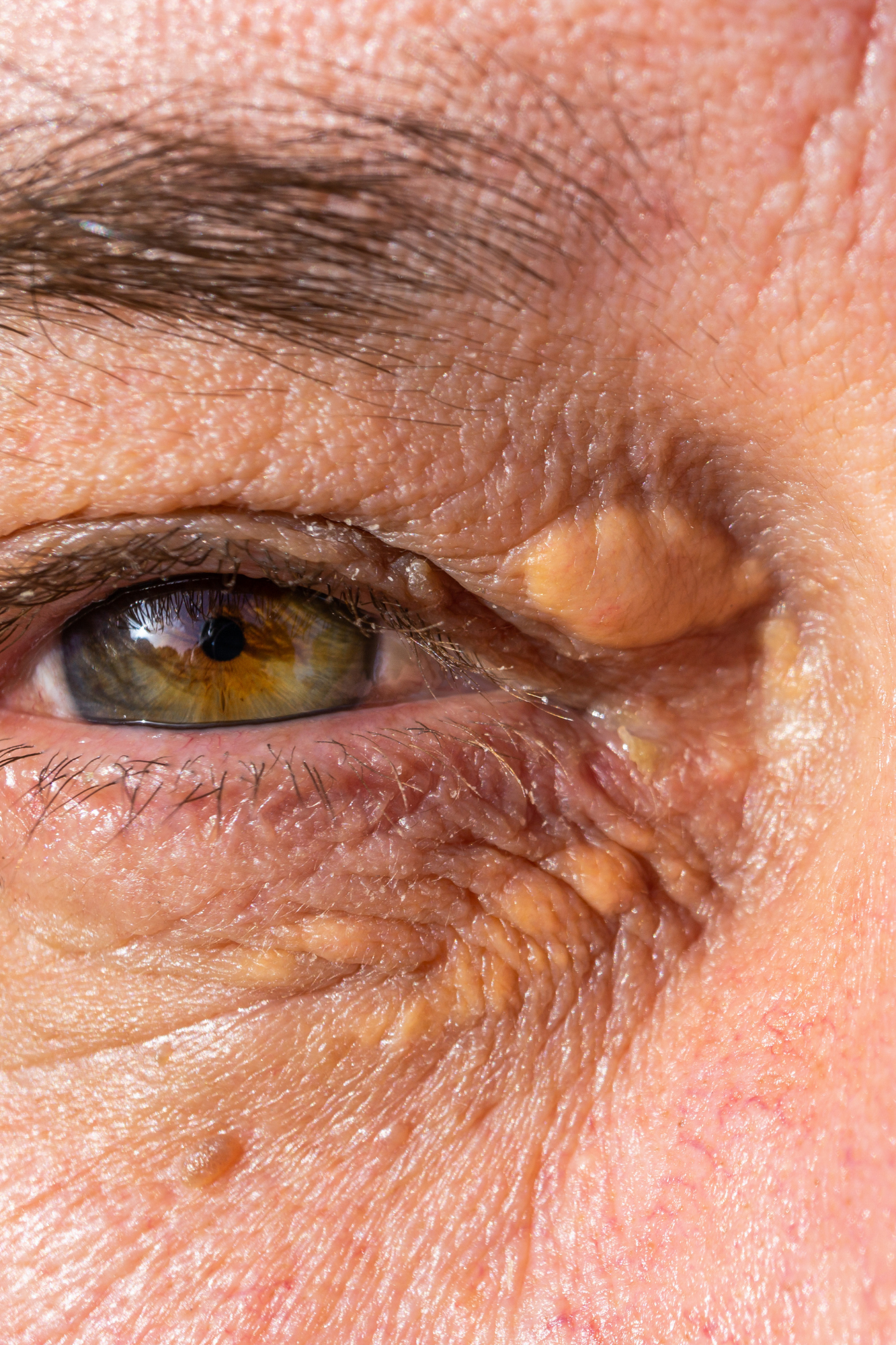 Close-up image of an old person's eye, showing large yellow Xanthelasma blemishes before removal