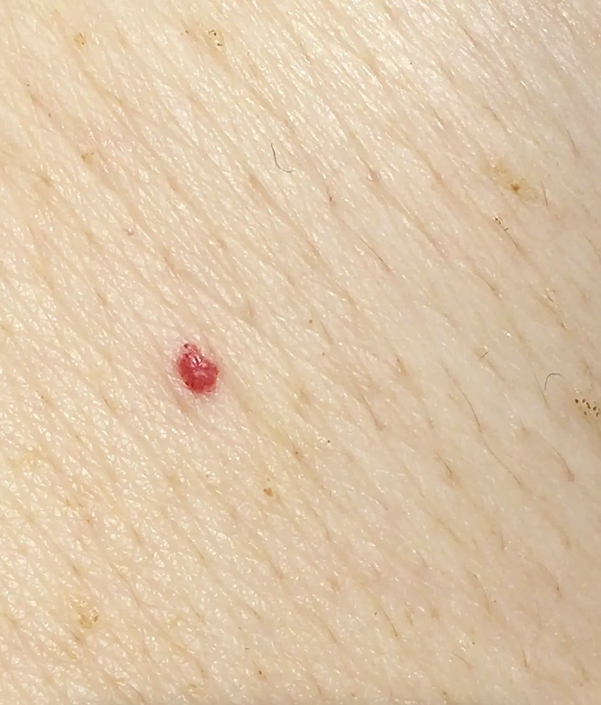 Close-up of skin with a small red cherry angiom campell de morgan blemish before treatment at dublin clinic