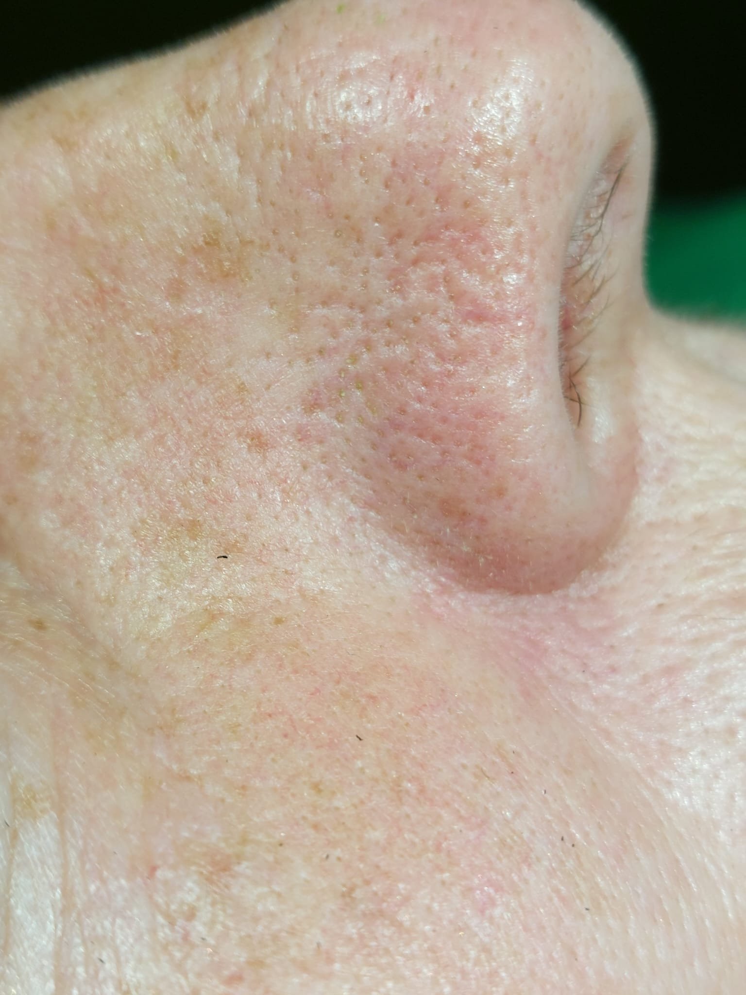 Close-up of skin after nose red spider vein removal at blemish removal clinic