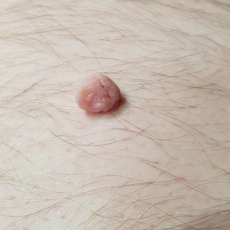 A close-up photo of a large pink, skin coloured raised skin tag growth on human skin before removal at the blemish removal clinic dublin