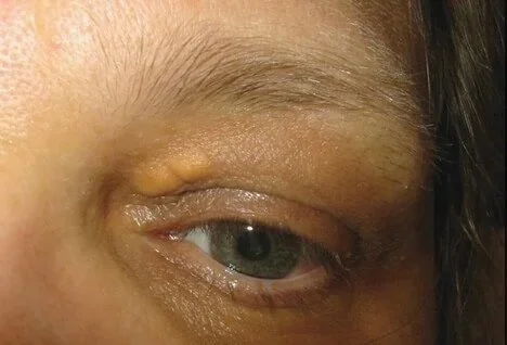 Close-up of a person's eye with large yellow Xanthelasma high cholesterol spot before removal from eyelid