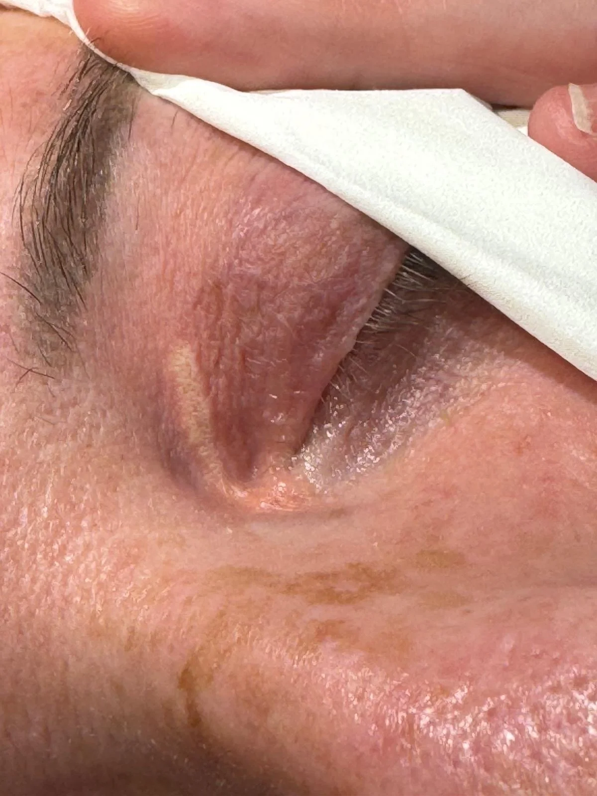 Xanthelasma skin blemish removal under eyes after treatmen at blemish removal clinic dublin