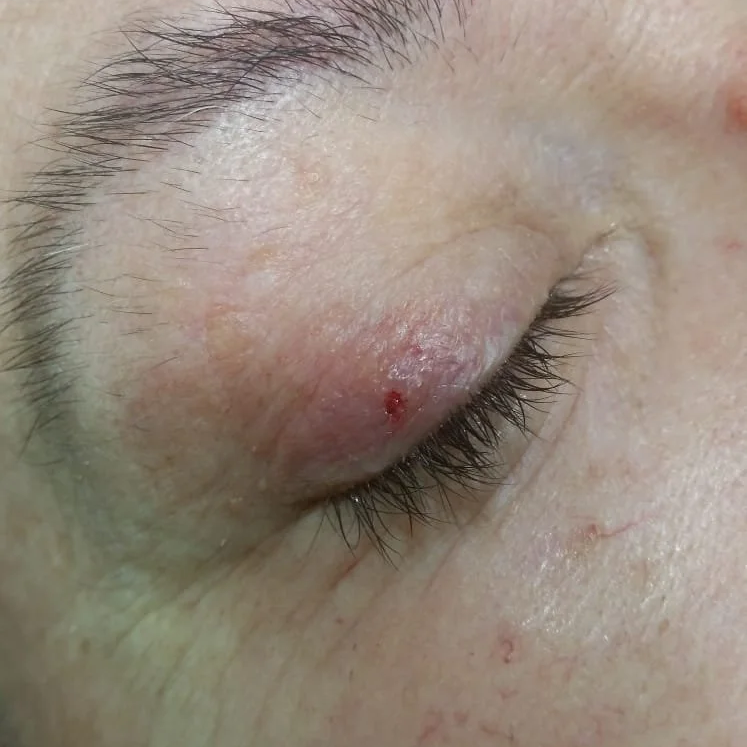 After showing successful, precise removal of a large skin tag on the upper eyelid with zero residual scarring.⁠
