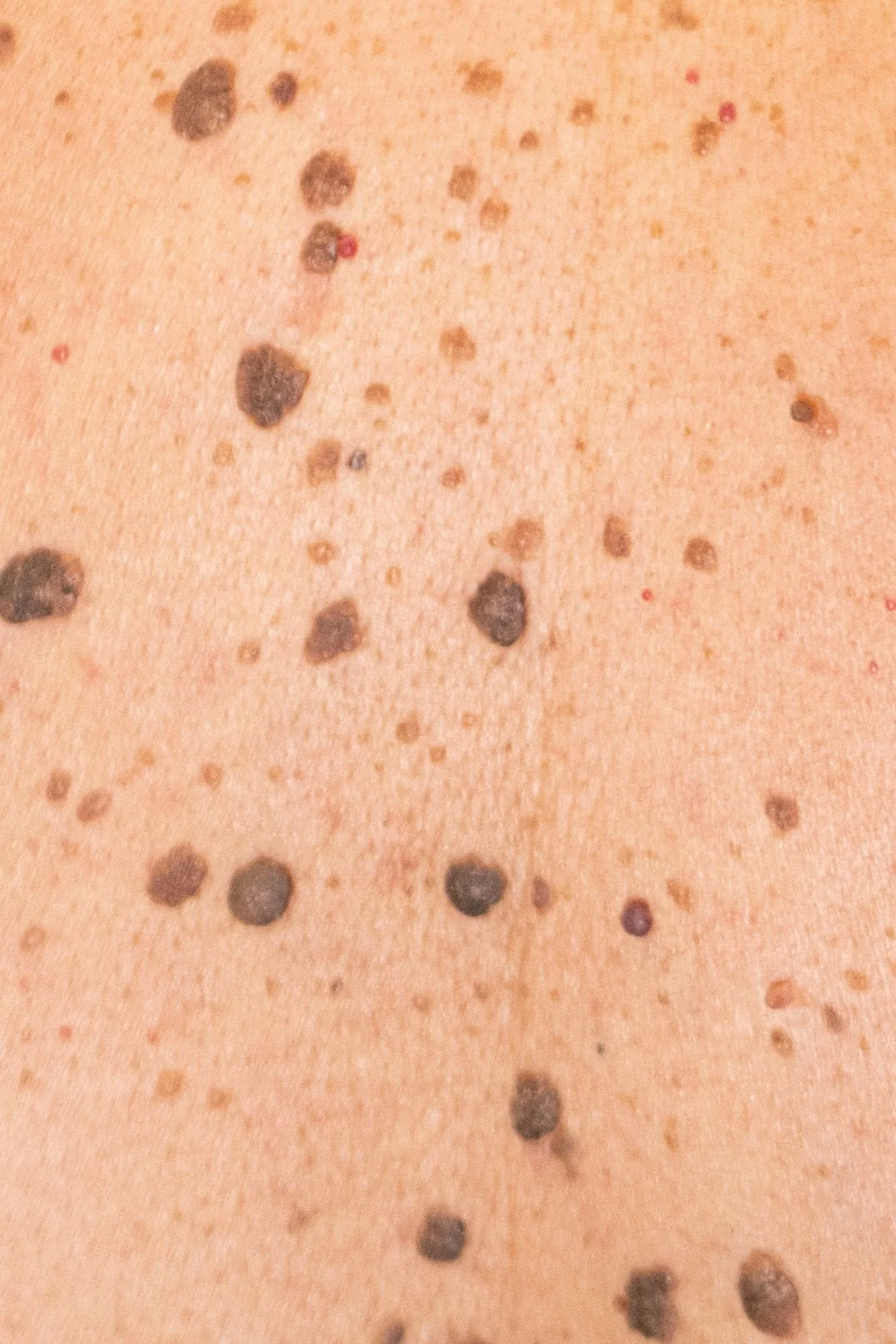 Close-up of a person's skin with numerous Seborrhoeic Keratosis spots and blemishes before removal in Dublin