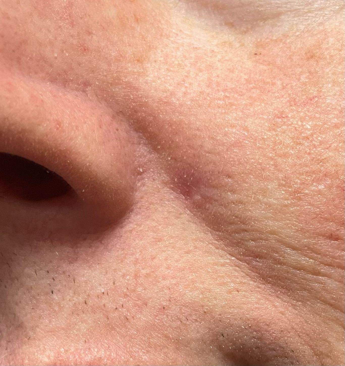 Close-up of unpigmented mole near nose after advanced electrolysis blemish removal treatment in dublin