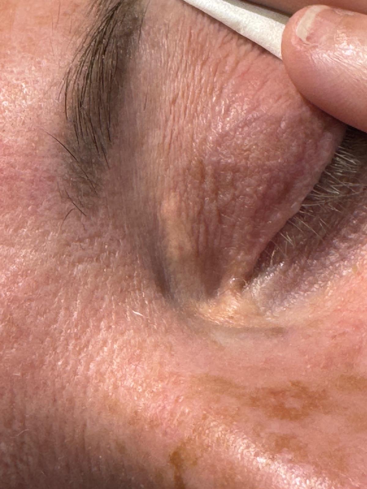 Xanthelasma Cholesterol Deposit Removal From Eyes In Dublin