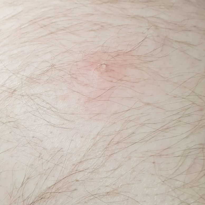 Close-up of a raised, flesh-coloured large pink skin tag after removal - skin blemish clinic
