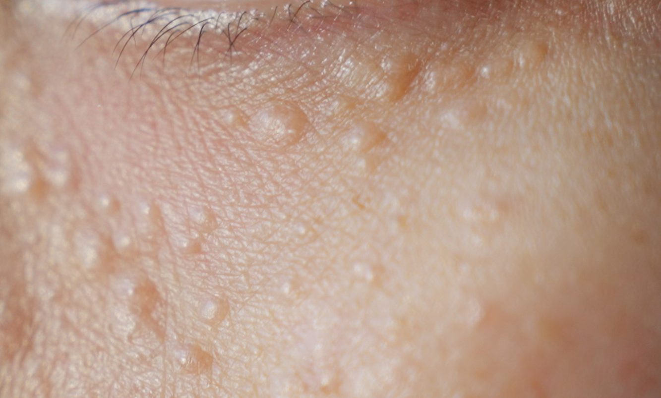 Close-up of under eye skin with visible Syringoma bumps and blemishes before treatment at blemish clinic