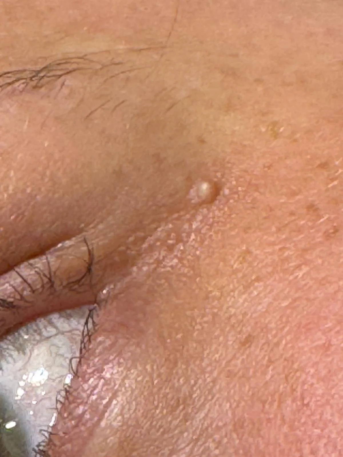 Close-up of a Milia small skin blemishes