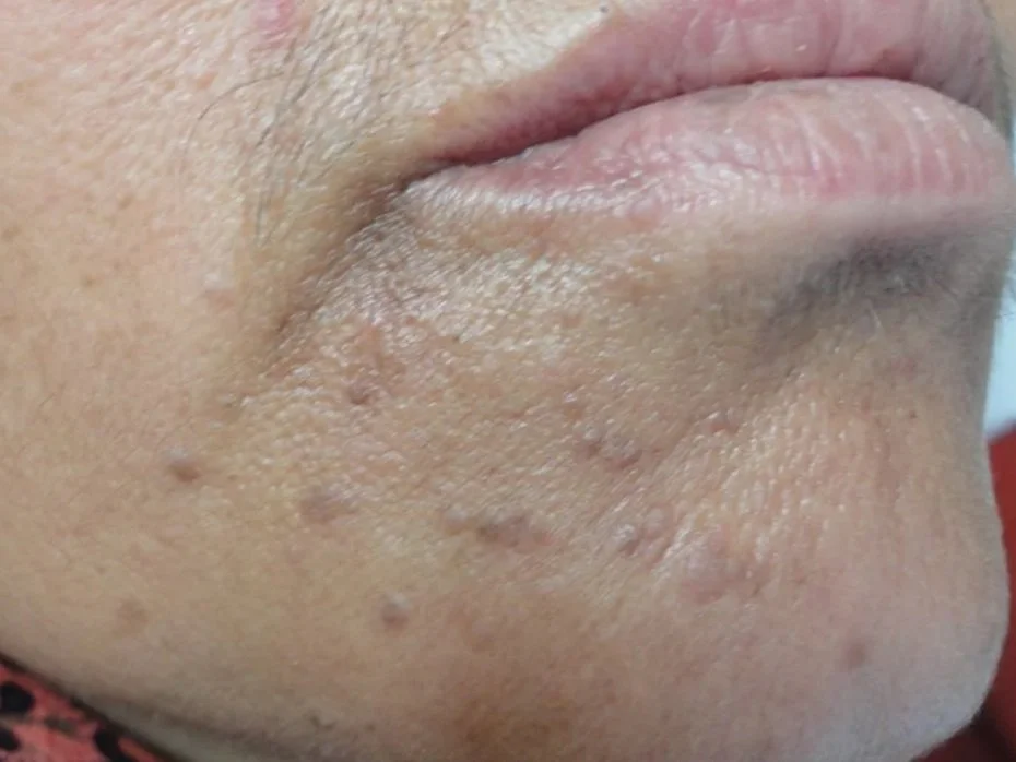 Close-up of a multiple small, raised plane & flat warts on the face and chin