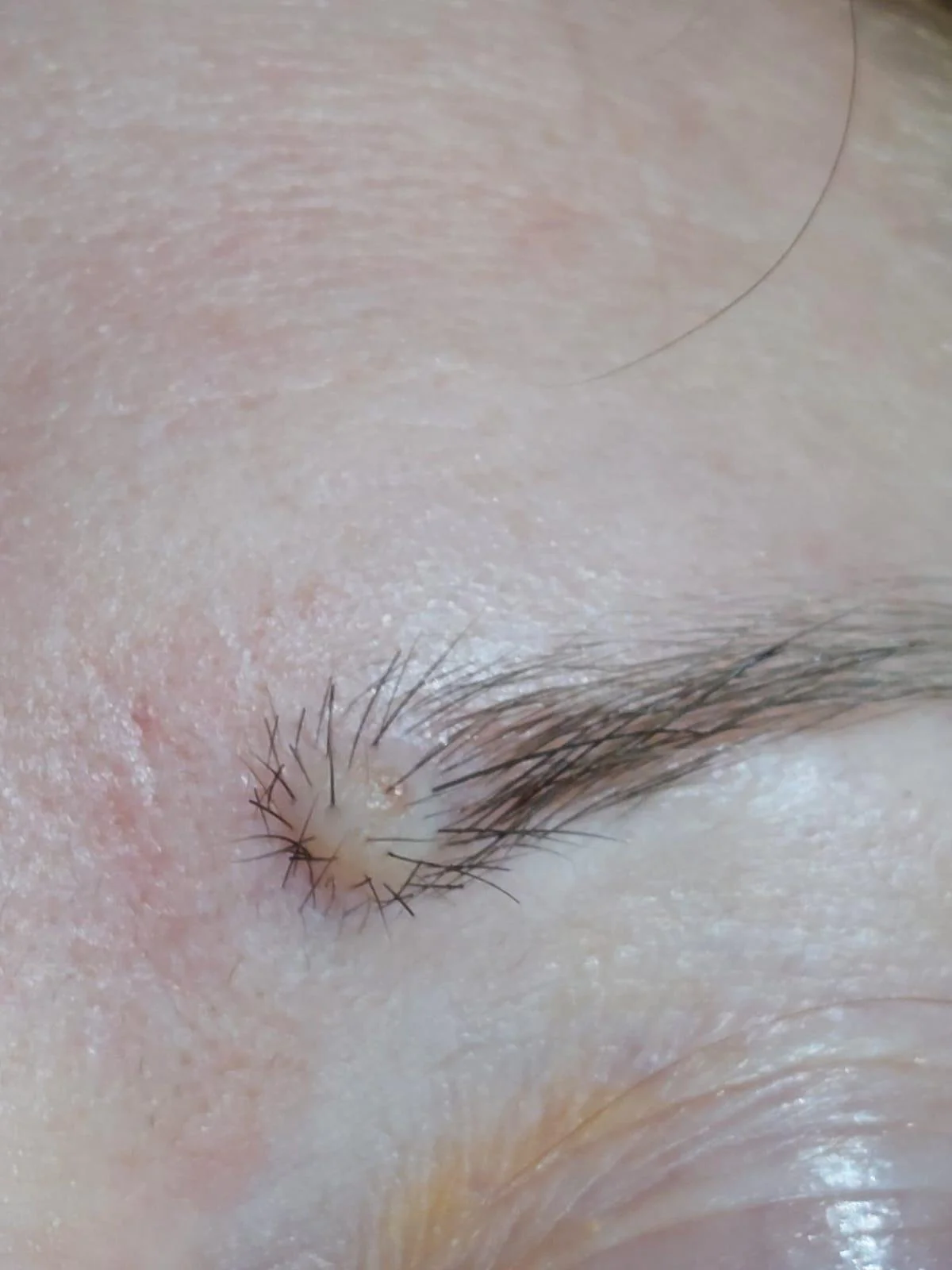 Close-up of a an unpigmented mole under eyebrow before removal treatment in dublin