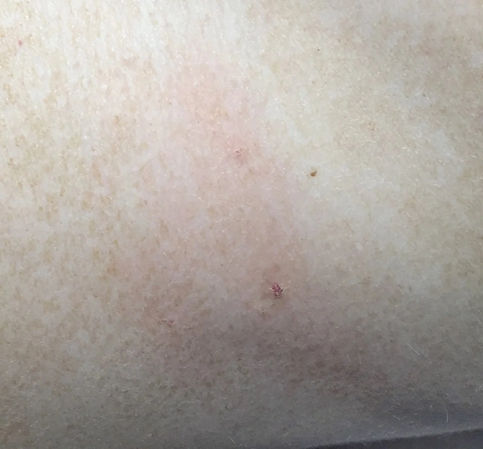 Close-up of human skin after red cherry angioma spot removal in dublin