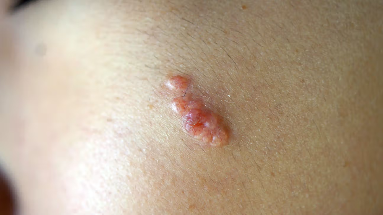 Close-up of a Sebaceous Hyperplasia blemish spots on skin before treatment at dublin clinic