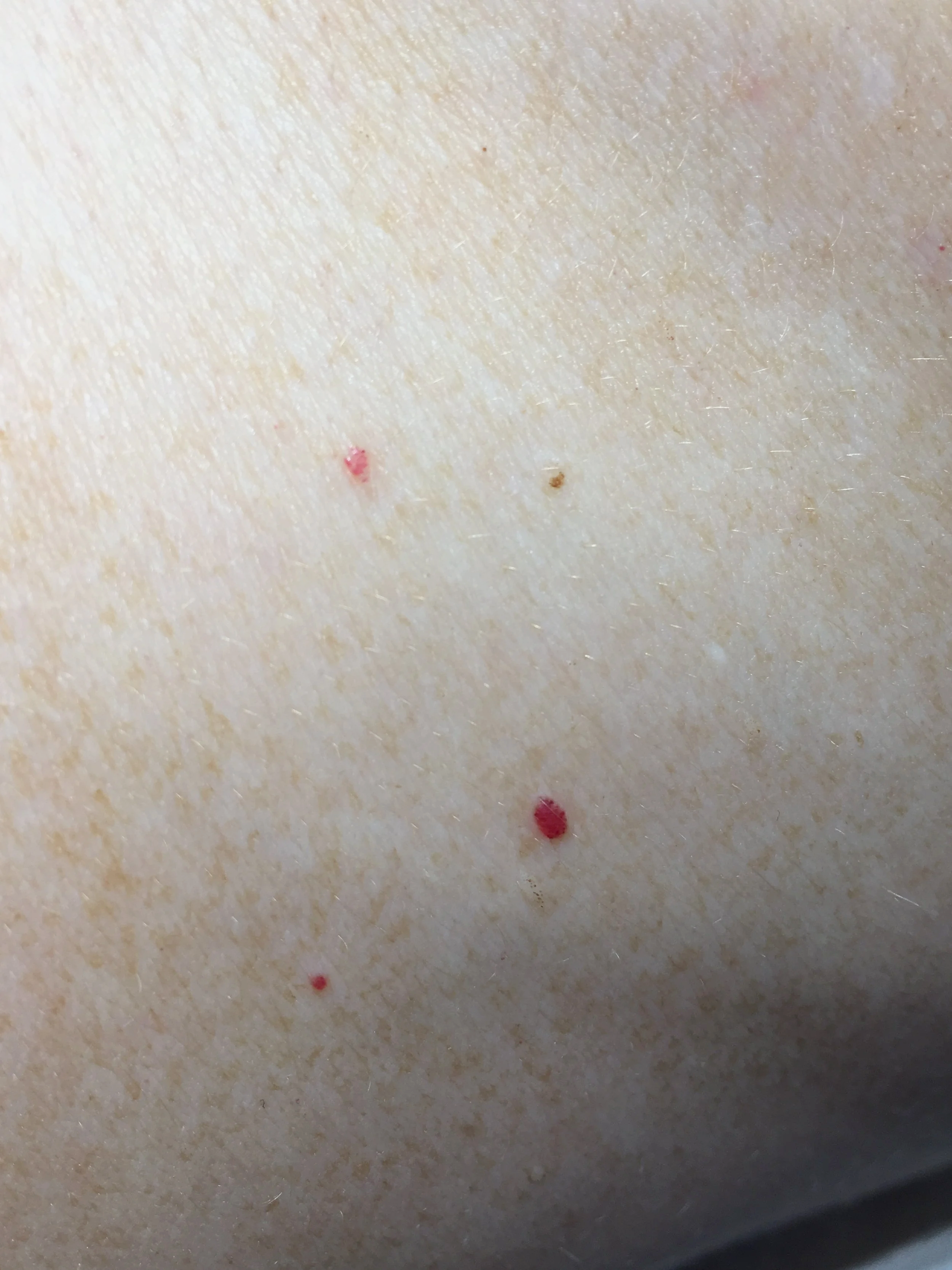 Close-up of a small red cherry angiomas on the body before removal in Dublin clinic