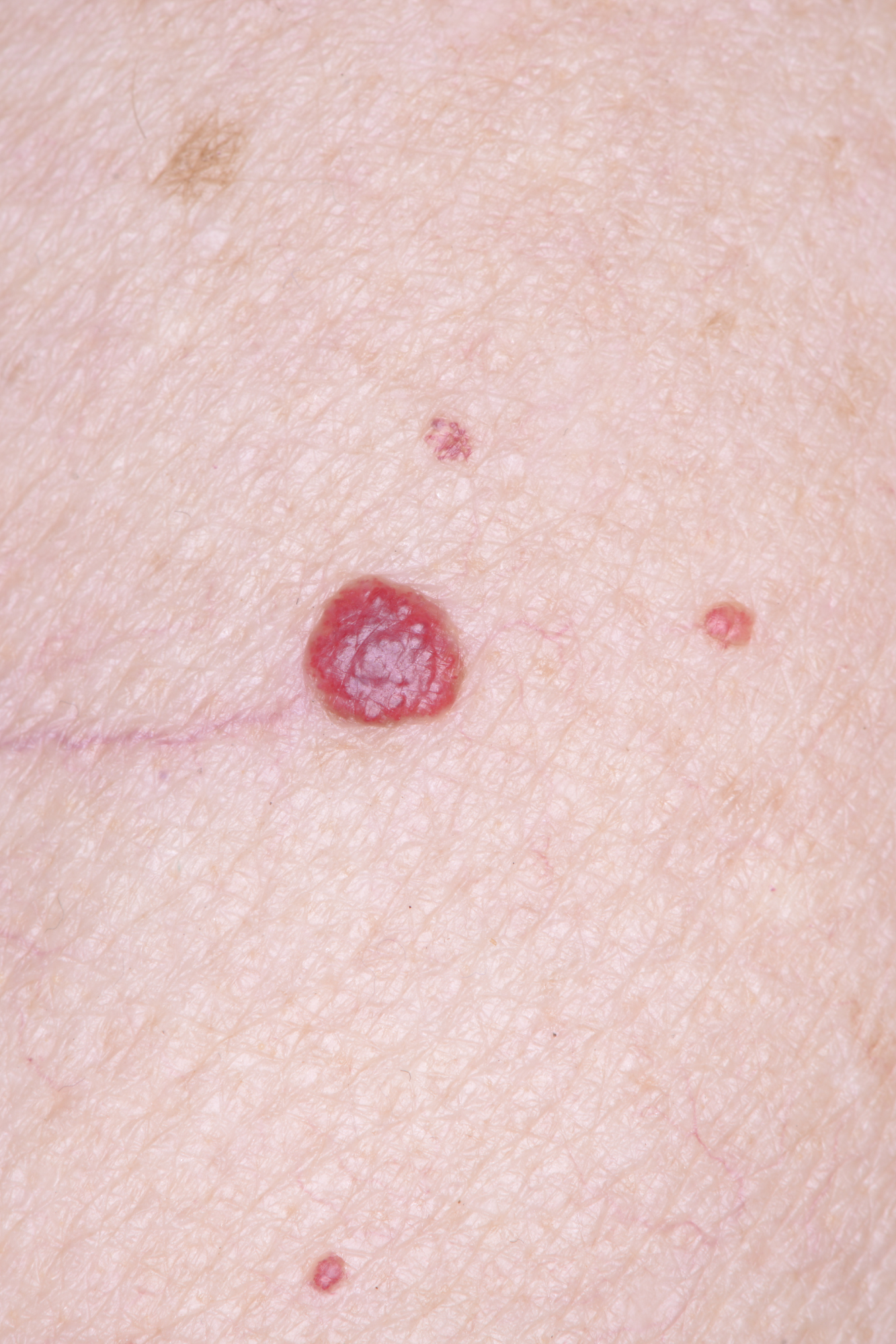 Close-up of skin with multiple cherry angioma red spots before removal at the blemish removal clinic dublin