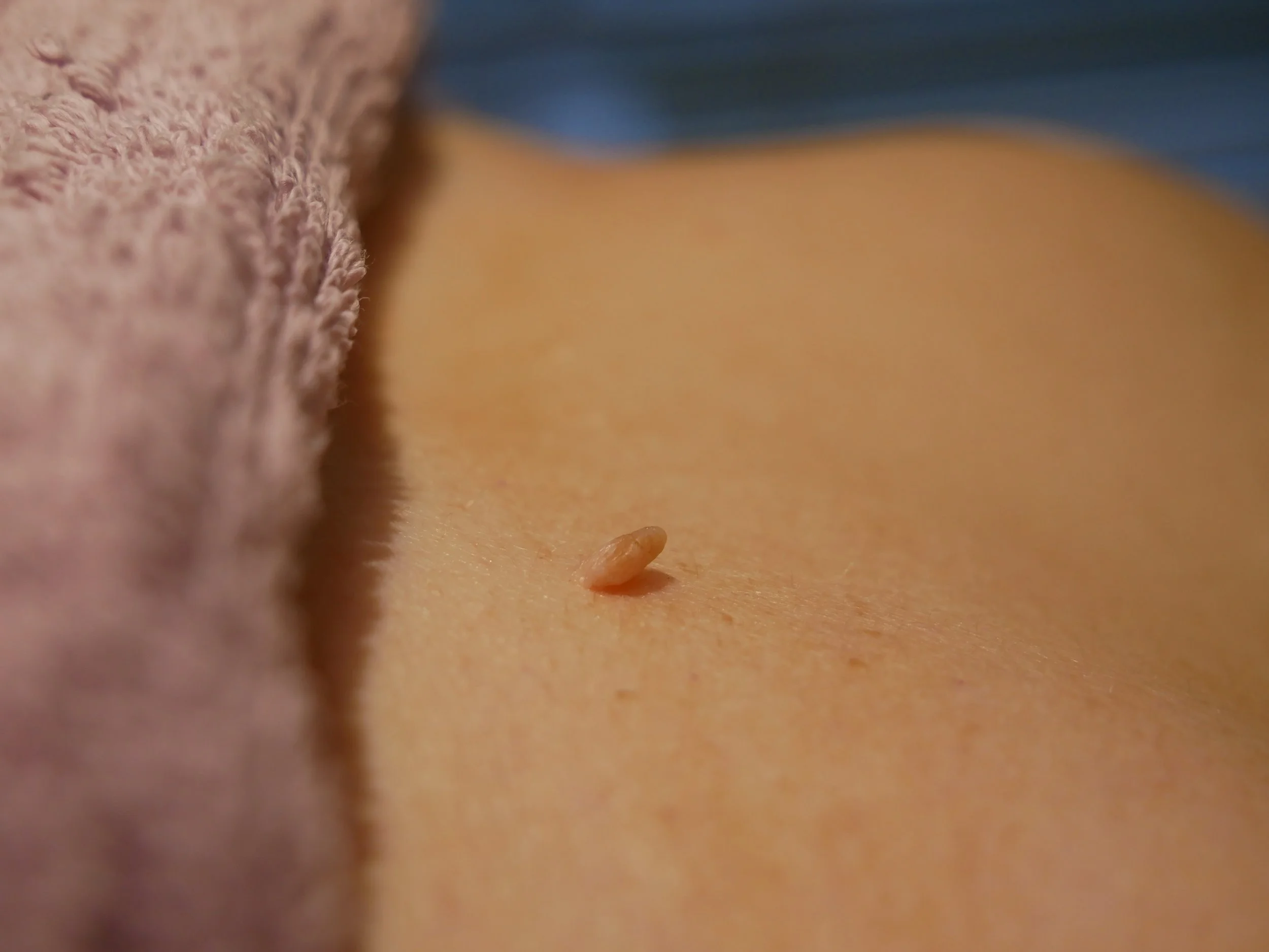 Close up of a raised skin tag on a friction area before professional blemish removal treatment in Dublin.⁠