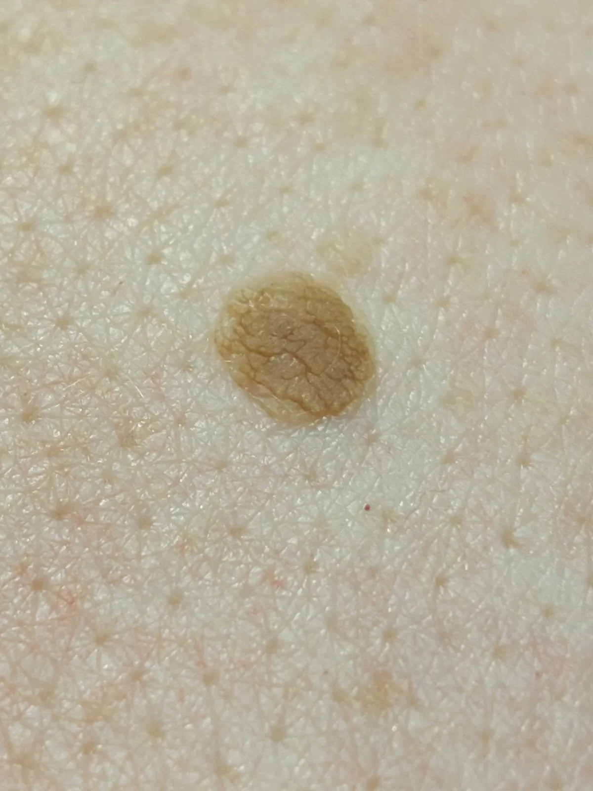 Close-up of crusty round brown Seborrhoeic Keratosis blemish spot on skin before removal