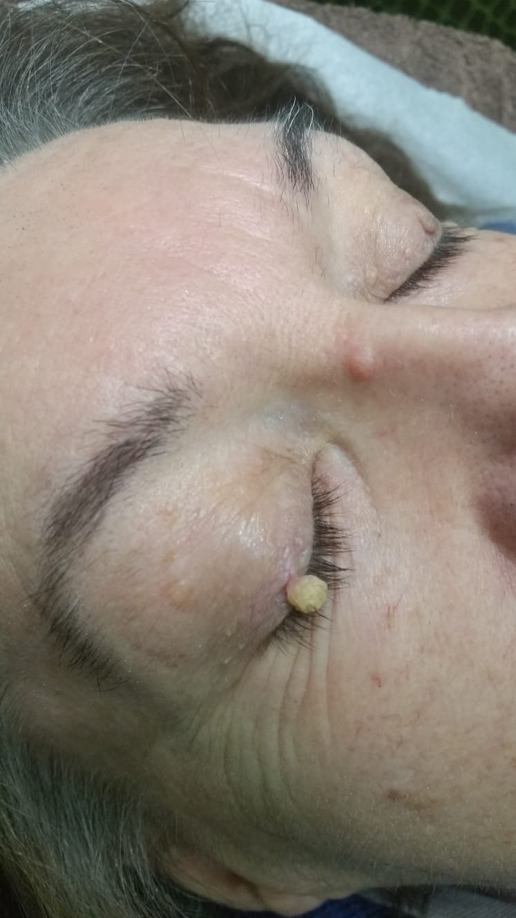 Close-up of a woman's face with her eyes closed, showing a large, yellowish skin tag near her nose.