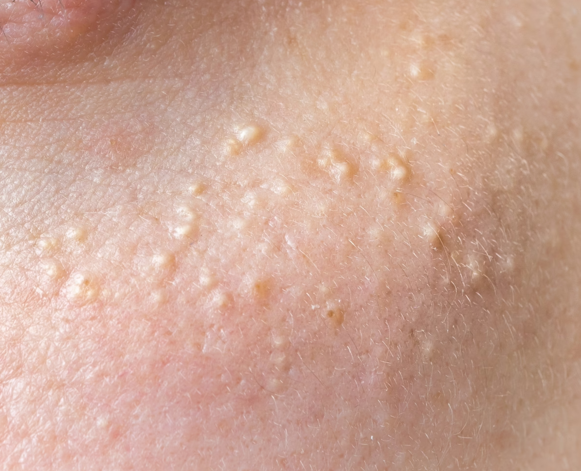 Close-up of skin under the eye with small keratin pimples and bumps getting removed by the blemish removal clinic dublin