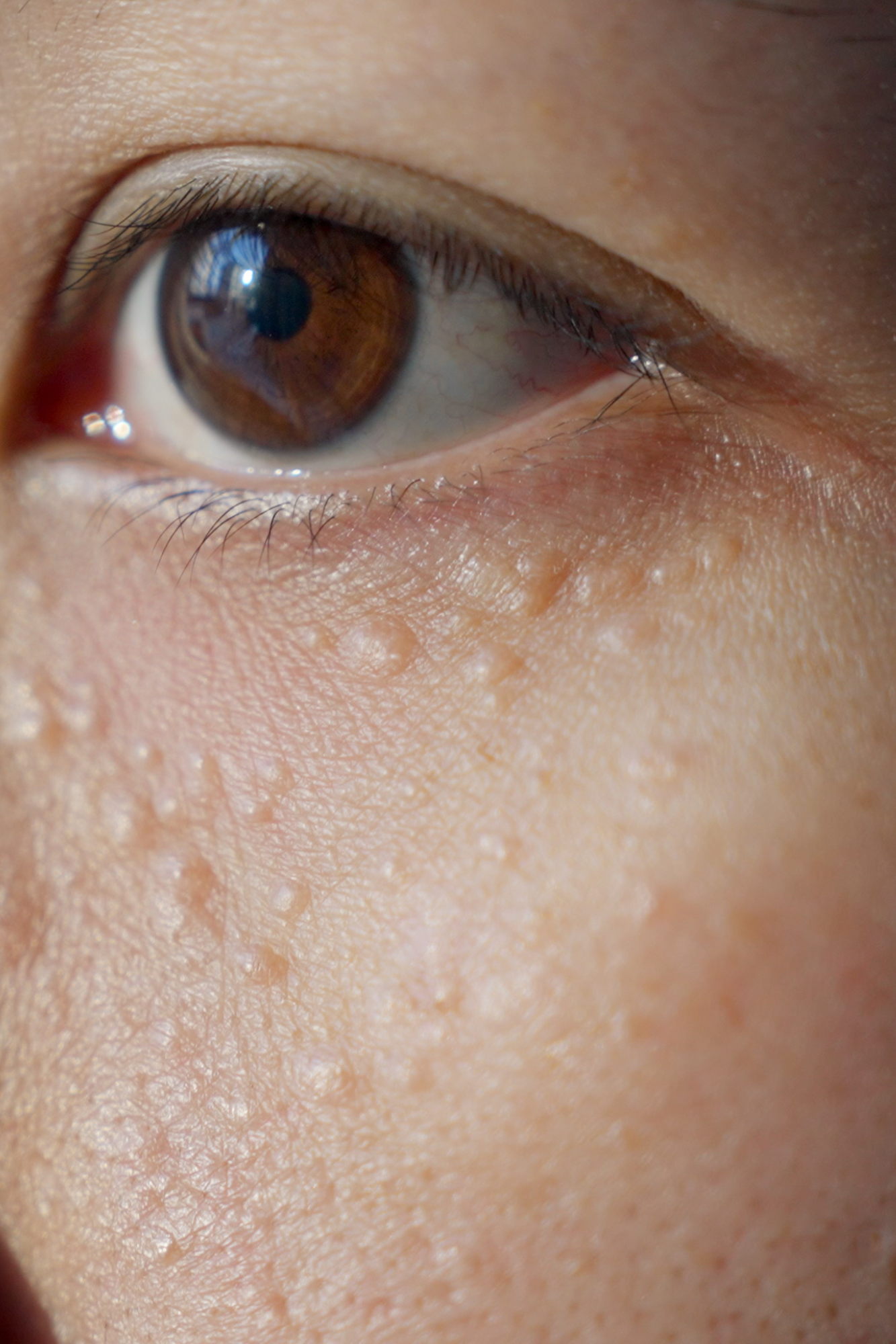 Close-up of a eye showing Syringoma blemishes in eye area before treatment
