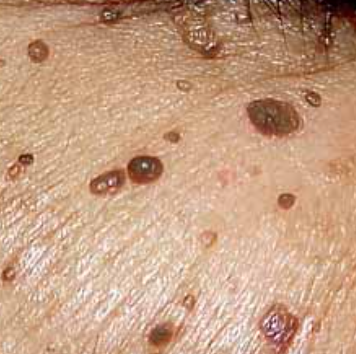 Close-up of skin with numerous small, dark Papulosa Nigra blemishes before removal
