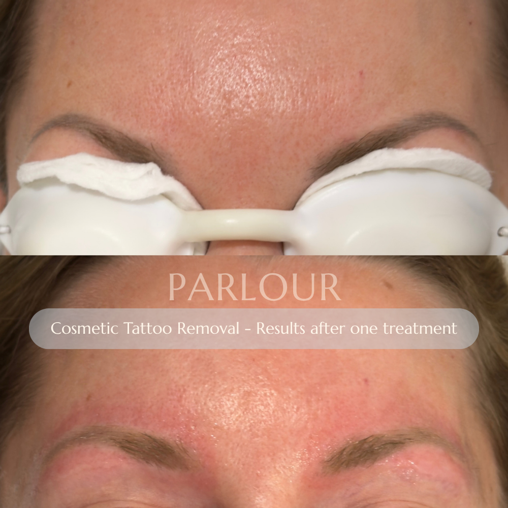 Cosmetic Tattoo Removal