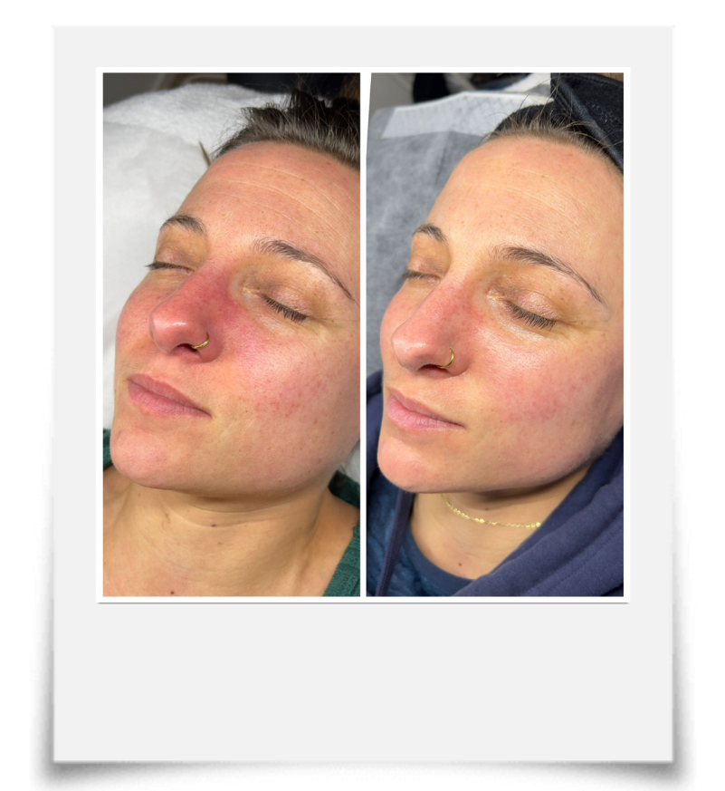 Before and after of microneedling