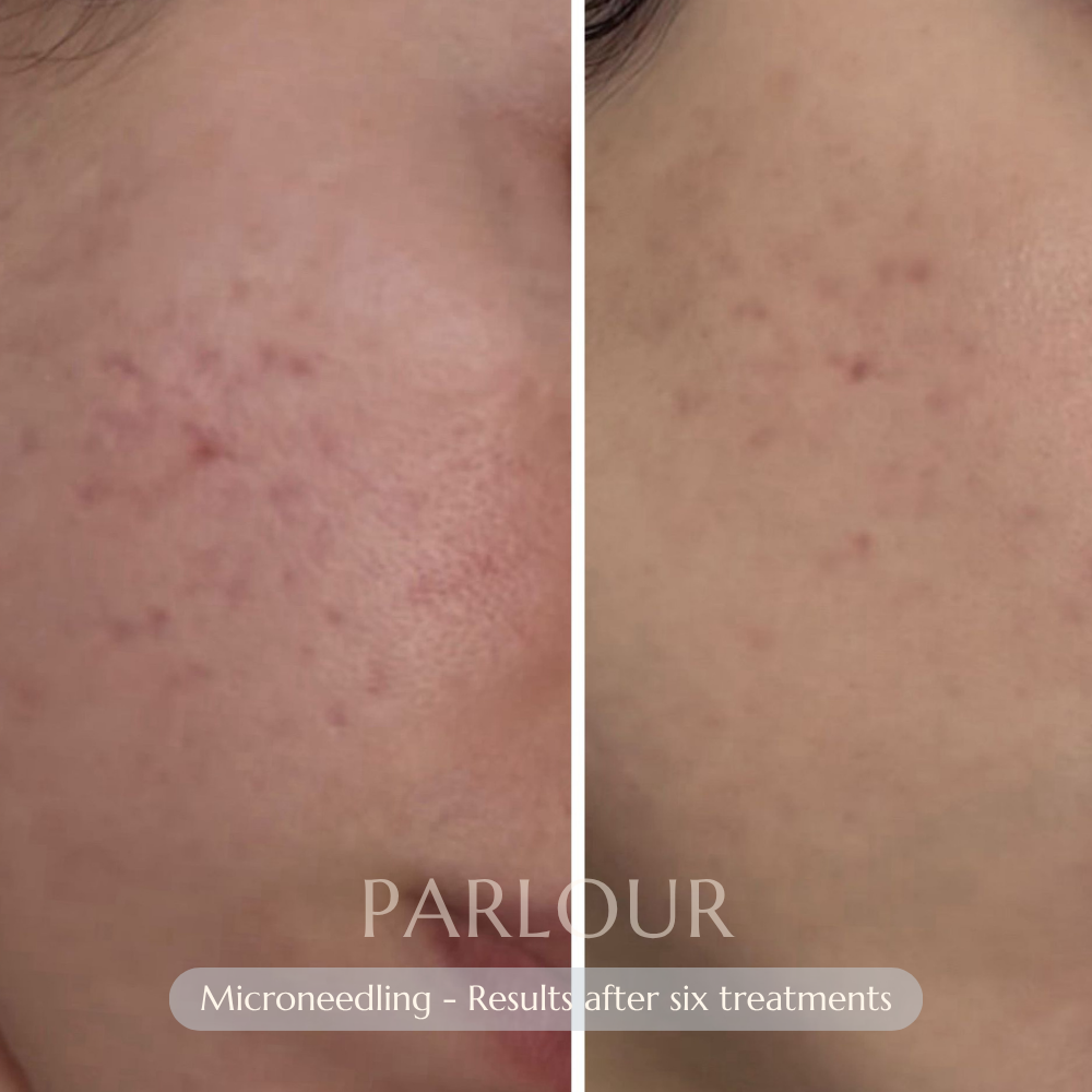 Microneedling Treatment