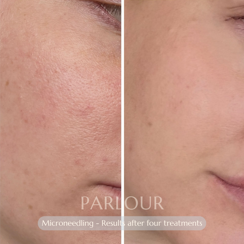 Microneedling Treatment