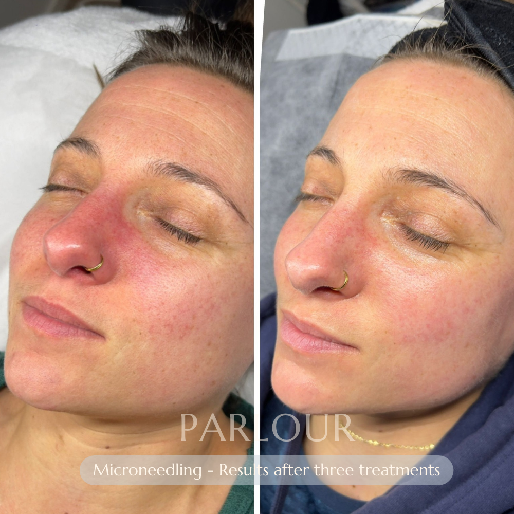 Microneedling Treatment