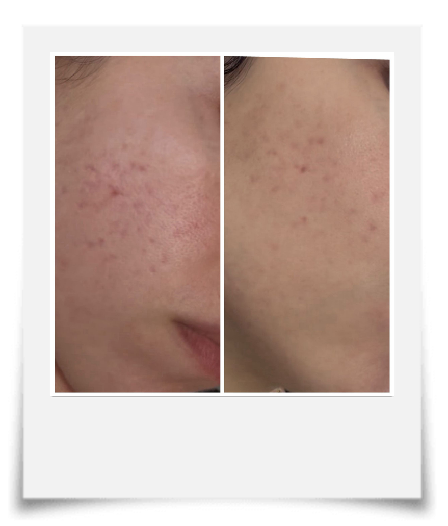 Side-by-side comparison of a person's cheek showing before and after skin treatment to reduce acne scars and redness.
