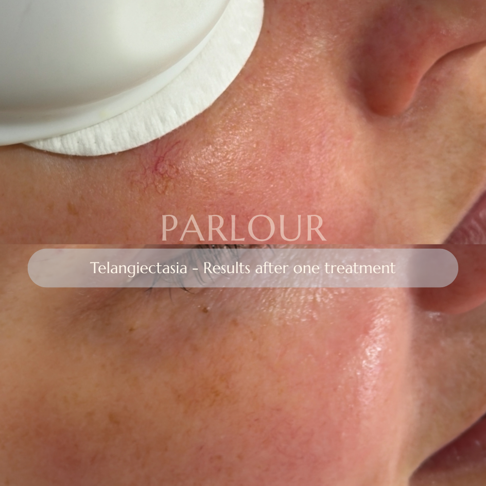 Telangiectasia Treatment