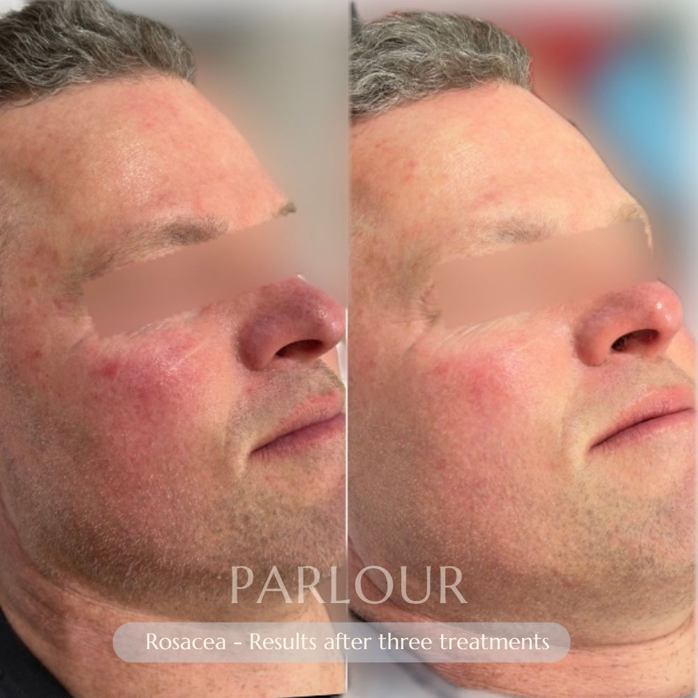 Rosacea Treatment