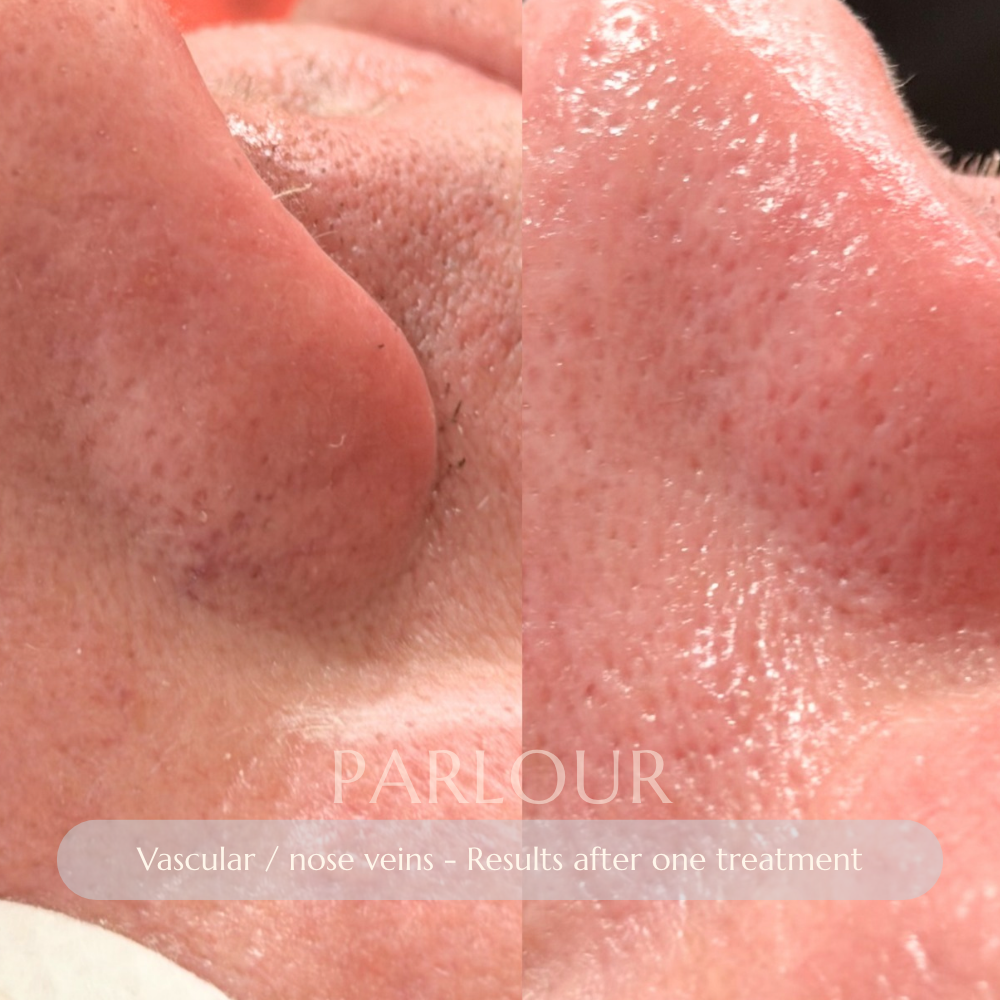 Facial Veins Treatment