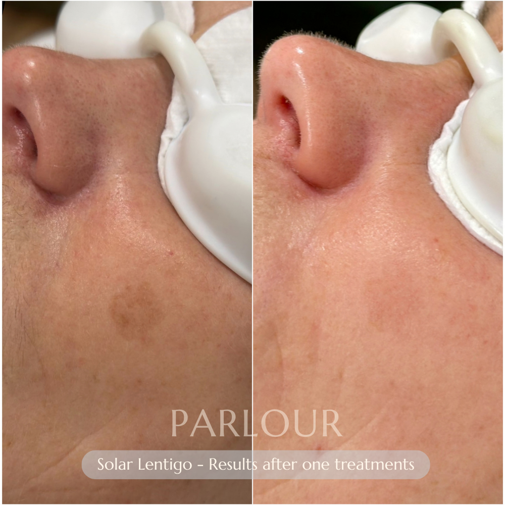 Solar Lentigo Laser Treatment
