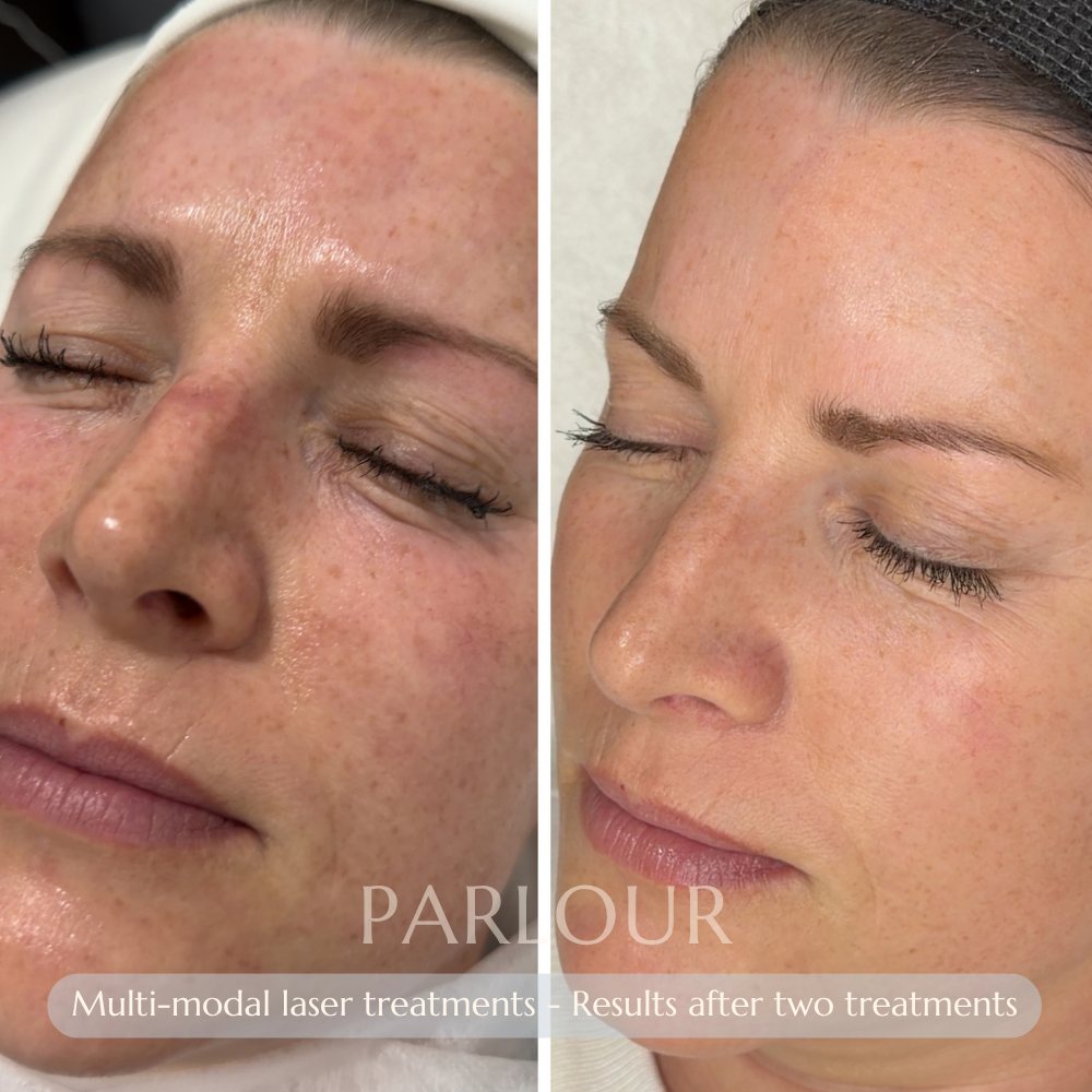 Multi-modal Laser Treatment