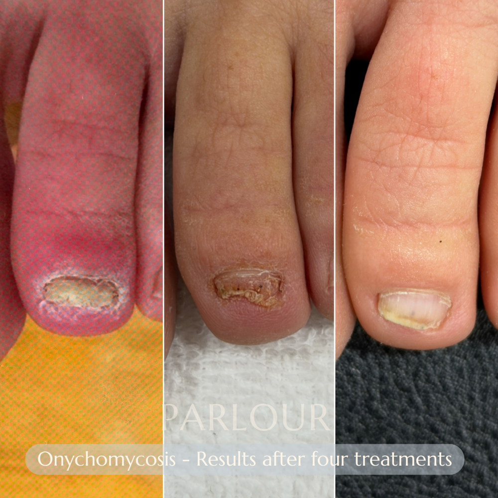 Nail Fungus Treatment
