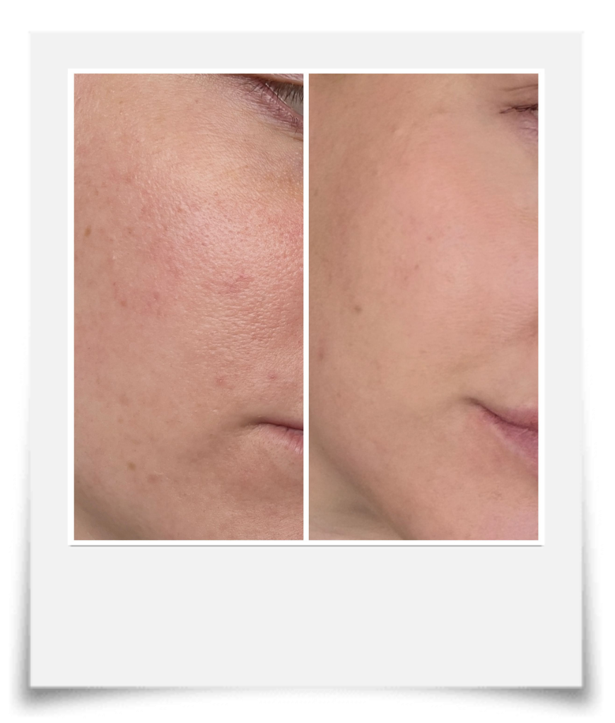 Before and after close-up images of a person's face showing improved skin texture and reduced redness.