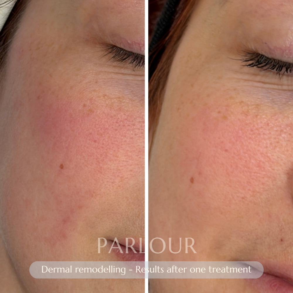 Dermal Remodelling Laser Treatment