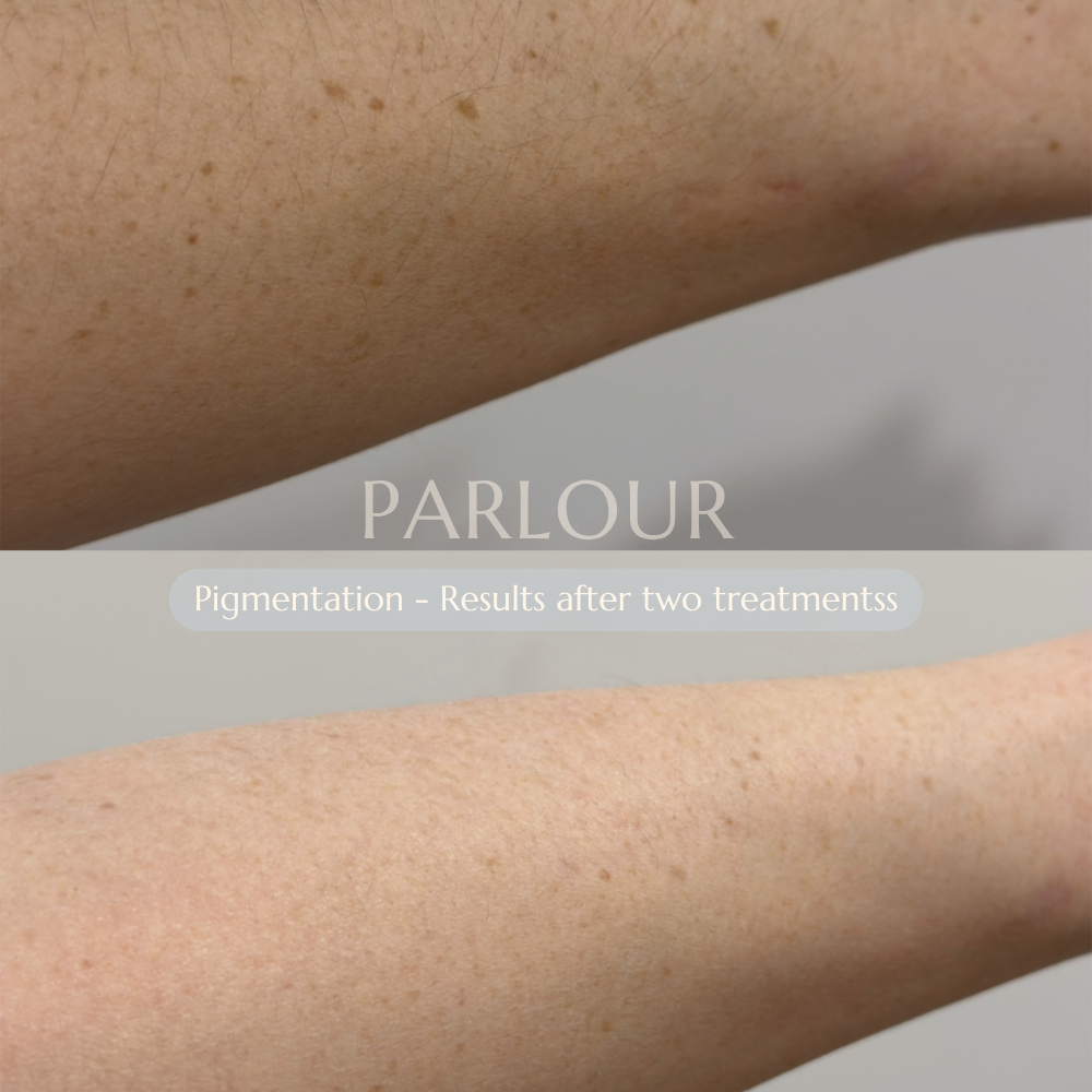 Pigmentation Treatment