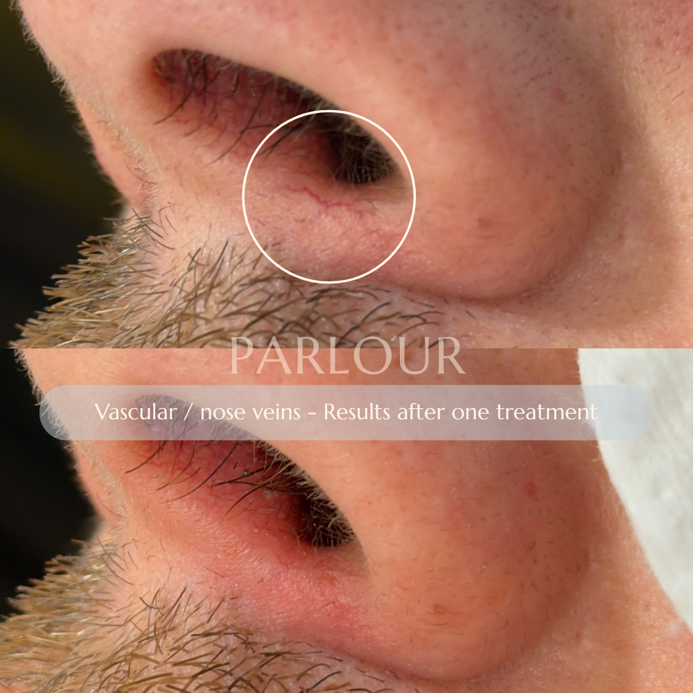 Facial Veins Treatment